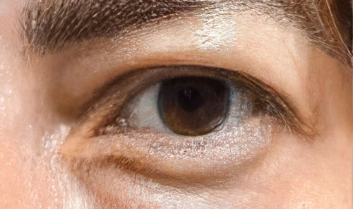 Non-invasive blepharoplasty - Before