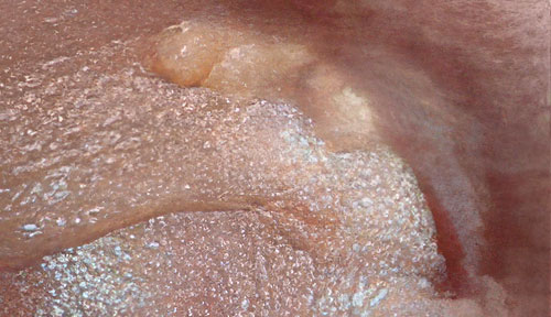 Xanthelasma - Before