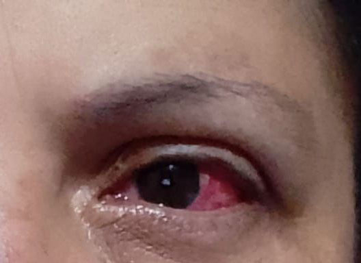 Ocular rosacea - Before