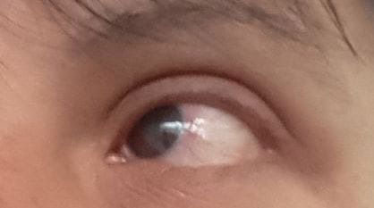 Ocular rosacea - After