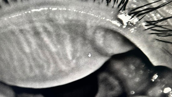 Blepharitis - Before